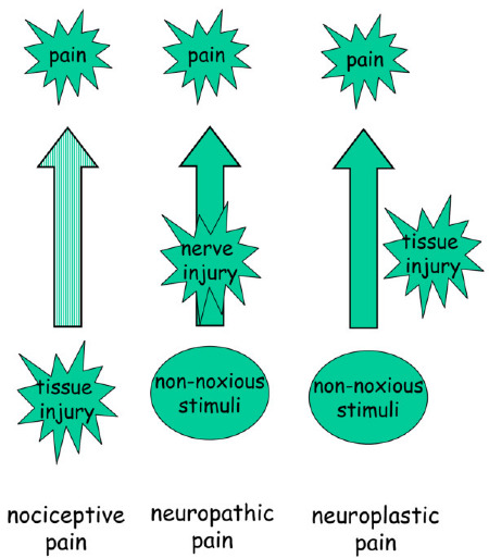 Pain Neuroplasticity, chronic pain relief clinic